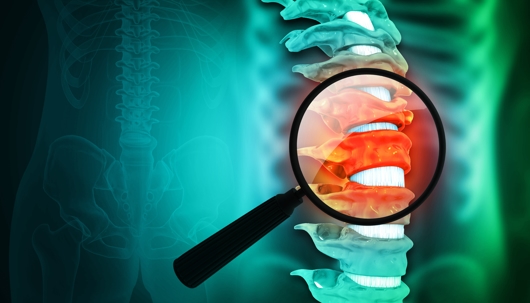 Lumbar intervertebral spine hernia. 3d illustration